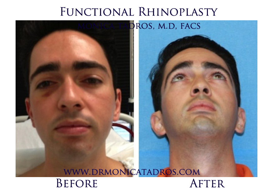 Rhinoplasty Cost in NJ & NYC Average Nose Job Cost