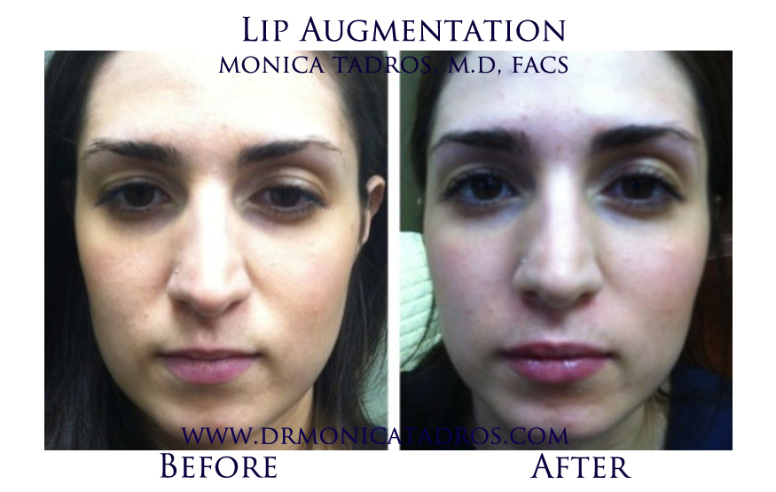 Lip Augmentation Before and After Photos of NJ Patients