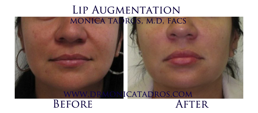 Love your Lips / Lip Augmentation Before & After A Dr. Monica