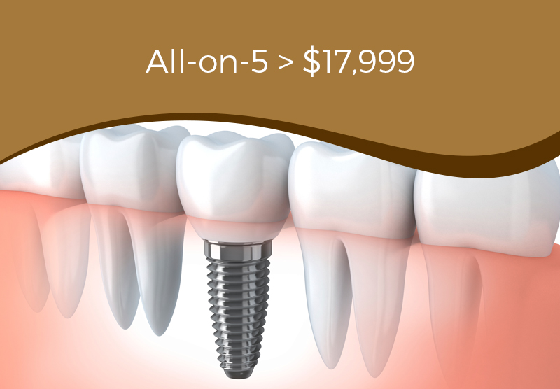 Allon5 Dental Implants M..Shoaib Khan, DMD, IL