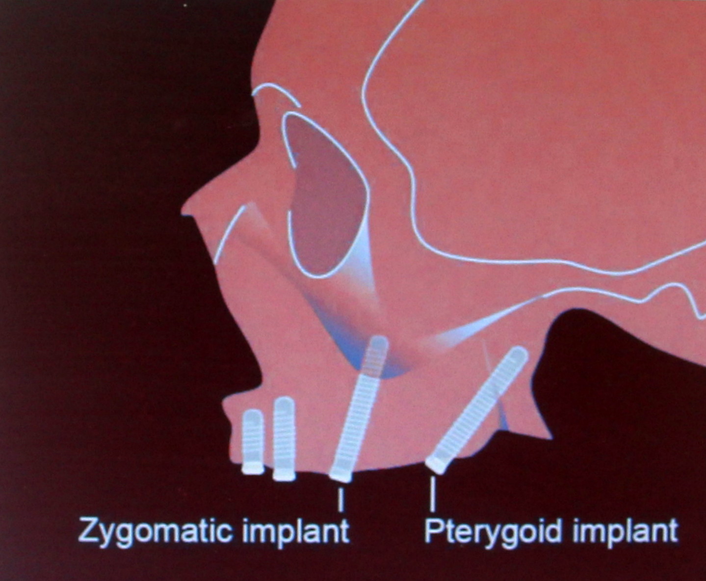 Tubero Pterygoid Implants BEST LASER DENTAL CLINIC & IMPLANT CENTRE