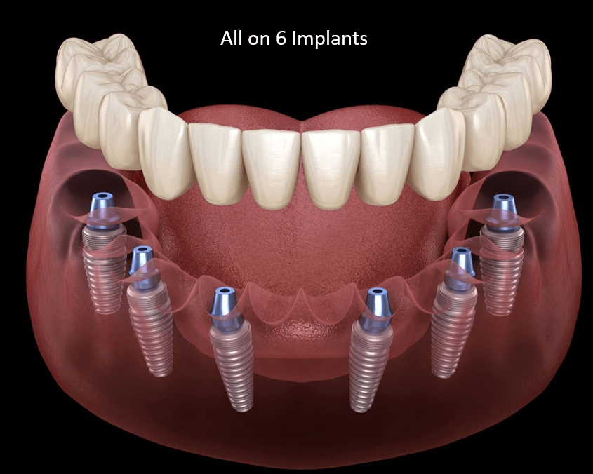 ALL ON 6 IMPLANTS BEST LASER DENTAL CLINIC & IMPLANT CENTRE