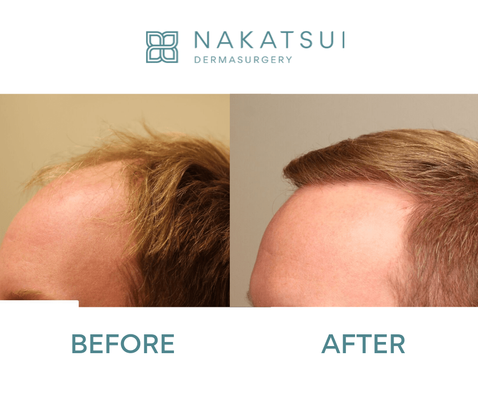 Ultrarefined Hair Transplant Edmonton Nakatsui Hair Transplant