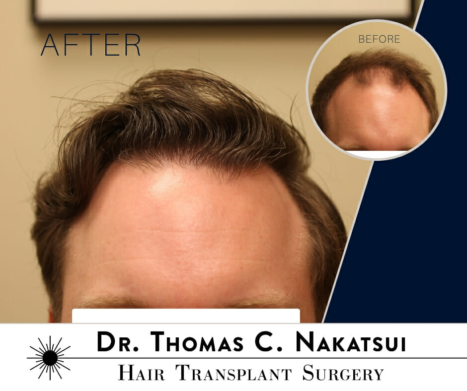 2,200 Graft Hair Transplant Surgery Dr. Thomas Nakatsui