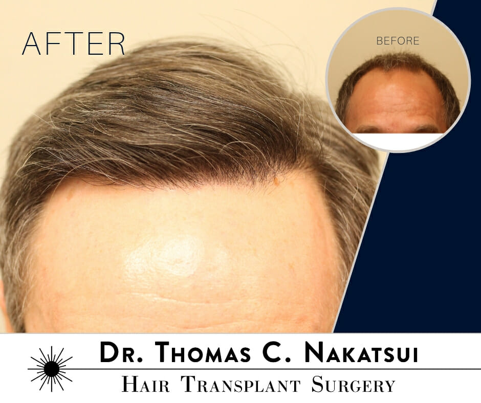 5100 Graft Hair Transplant Surgery Edmonton