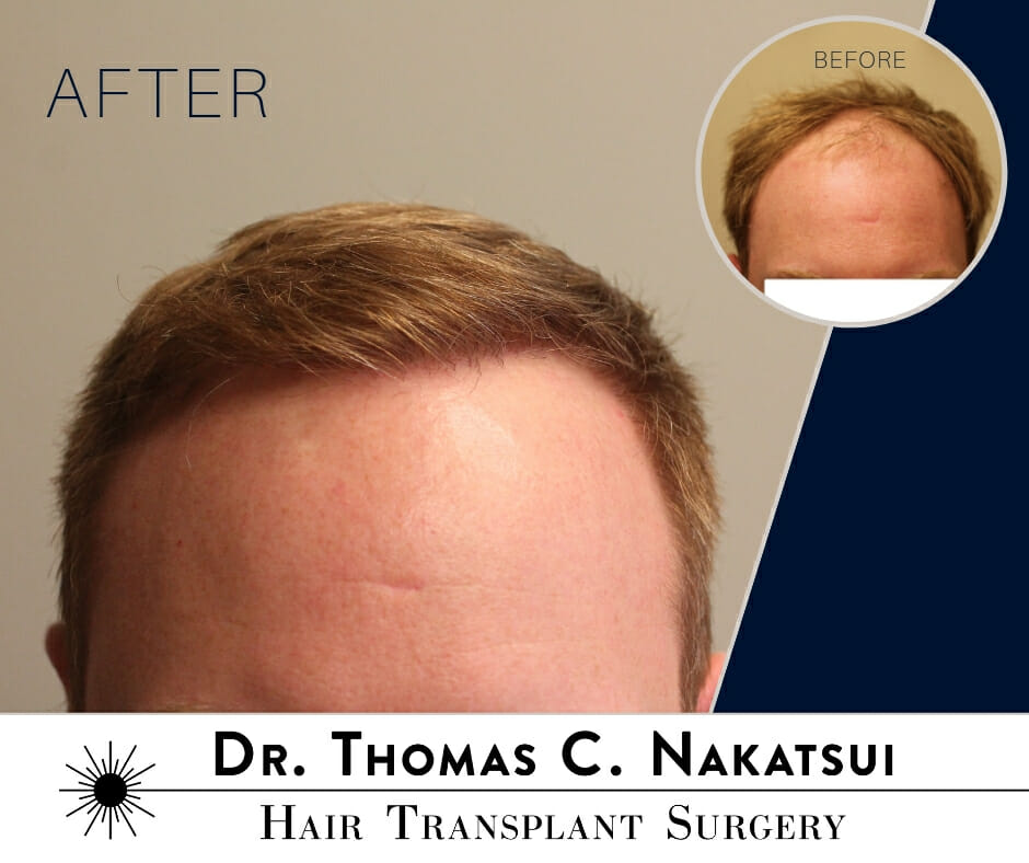 2400 Graft Hair Transplant Surgery Edmonton