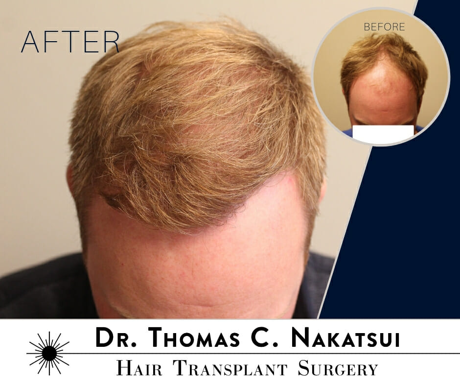 2400 Graft Hair Transplant Surgery Edmonton