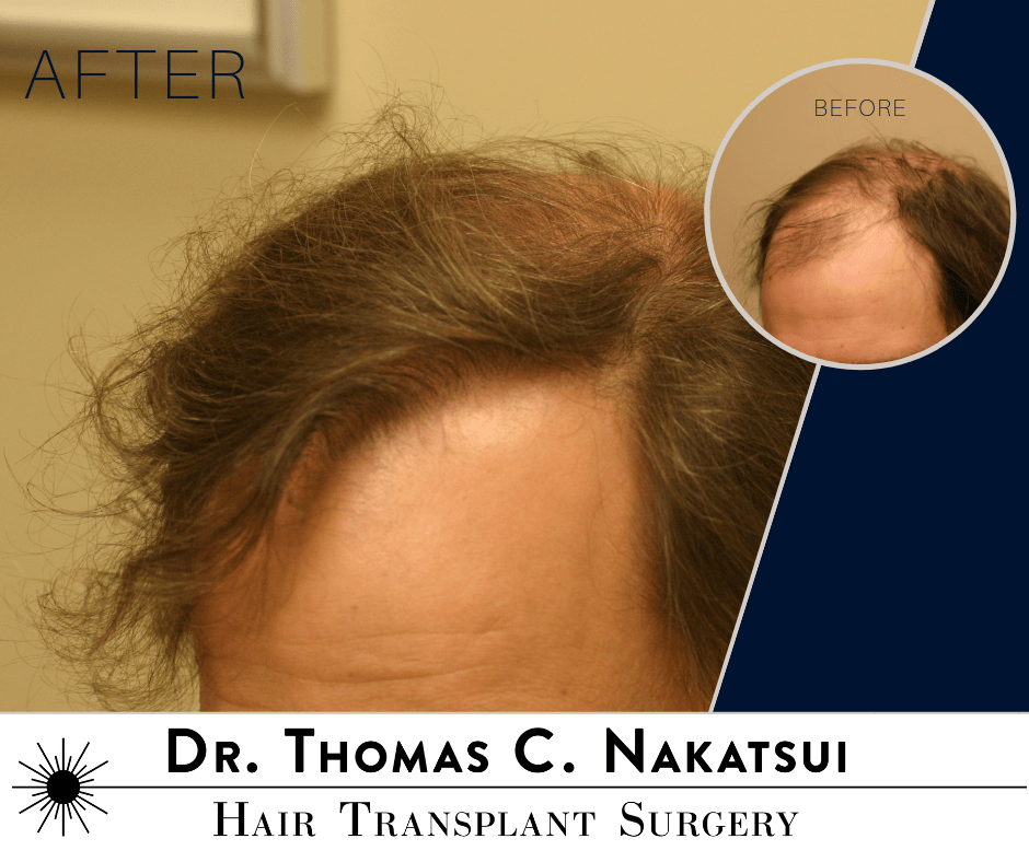 3,000 Graft Hair Transplant Surgery Dr. Thomas Nakatsui Hair