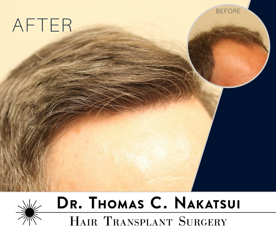 5100 Graft Hair Transplant Surgery Edmonton