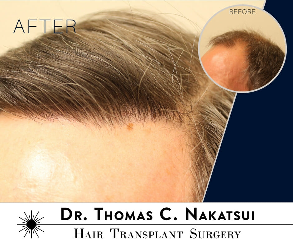 5100 Graft Hair Transplant Surgery Edmonton