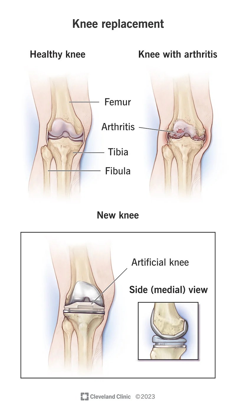Knee Replacement Surgery Orthopaedic