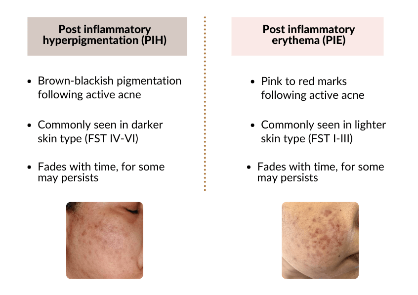 Red scars or Post inflammatory erythema Dr Naphisabet Wanniang