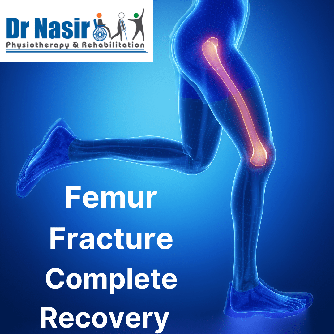 Femur Fracture Treatment in Uttam Nagar Dr Nasir Physiotherapy