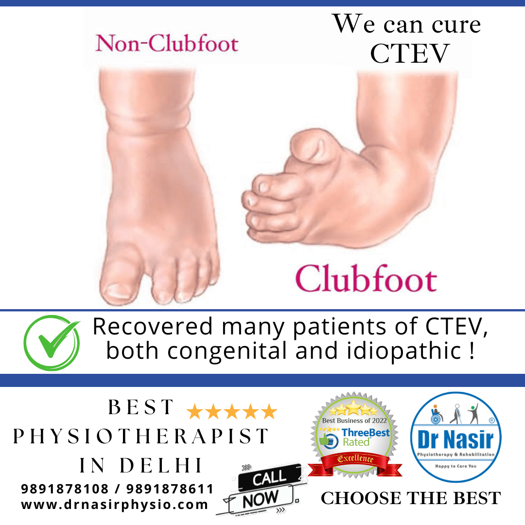 Club Foot Treatment in Dwarka Dr NasirPhysiotherapy and Rehabilation