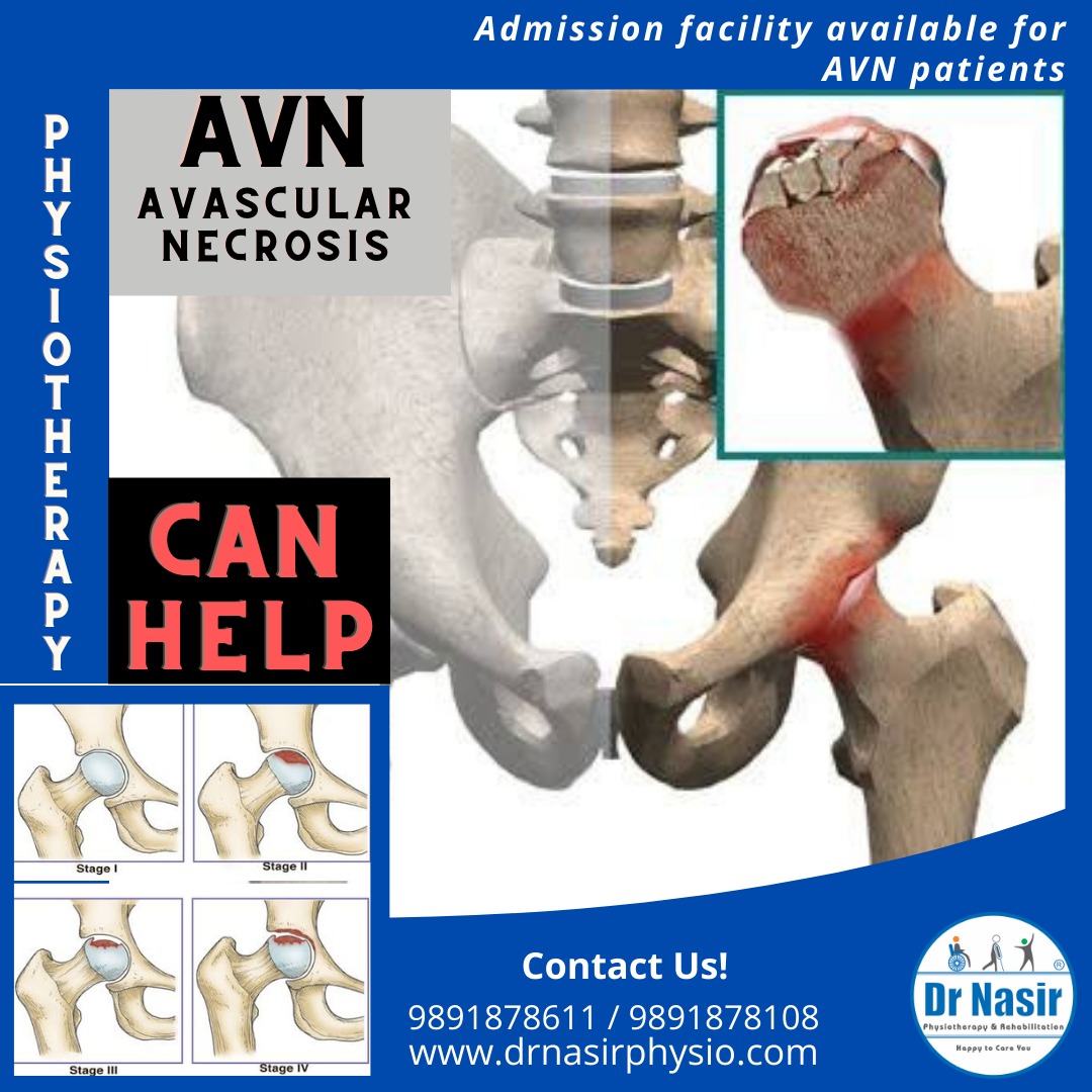 Avascular Necrosis (AVN) Dr NasirPhysiotherapy and Rehabilation