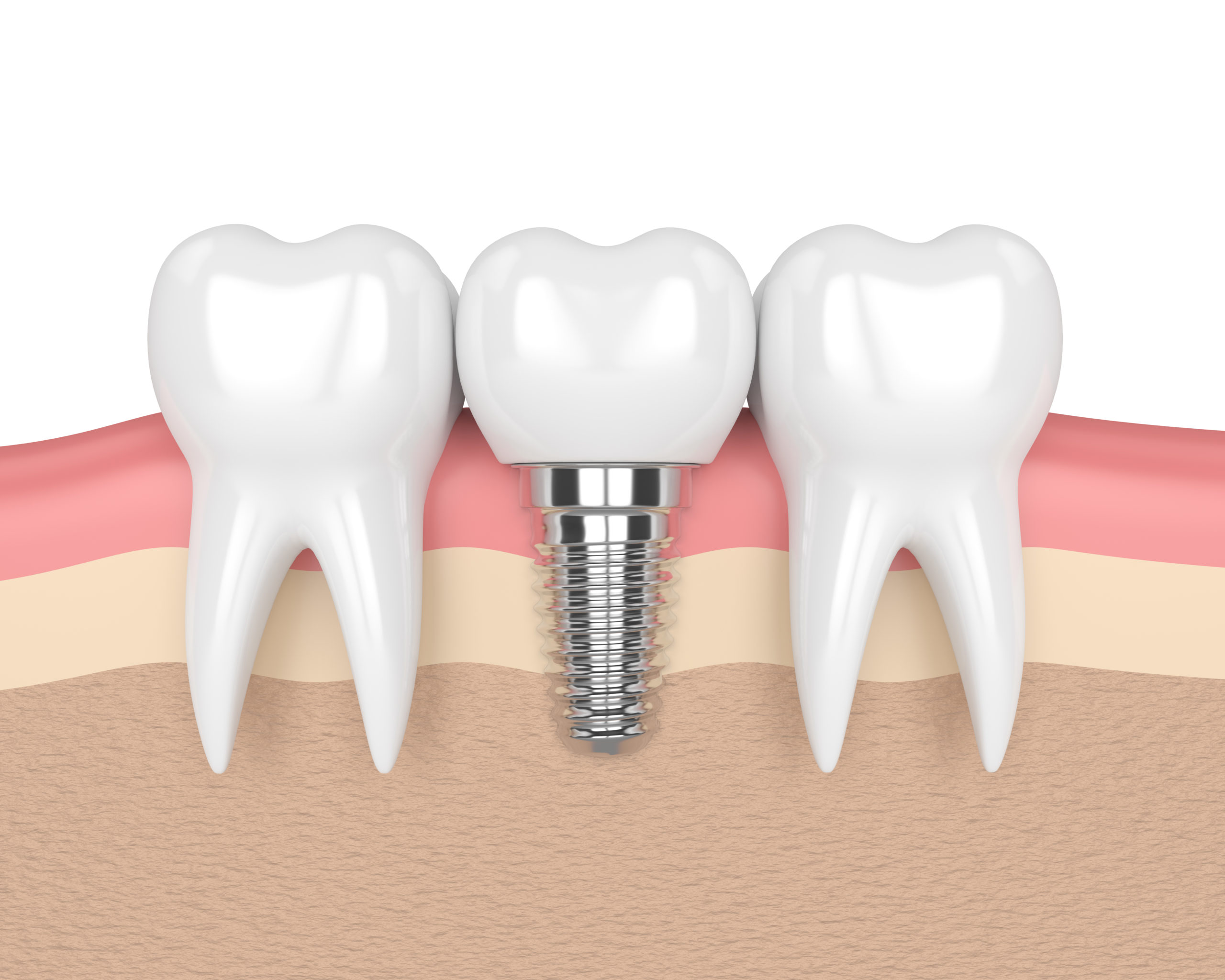 Tooth replacement options Dr. Nate Dental North Bergen Dentist