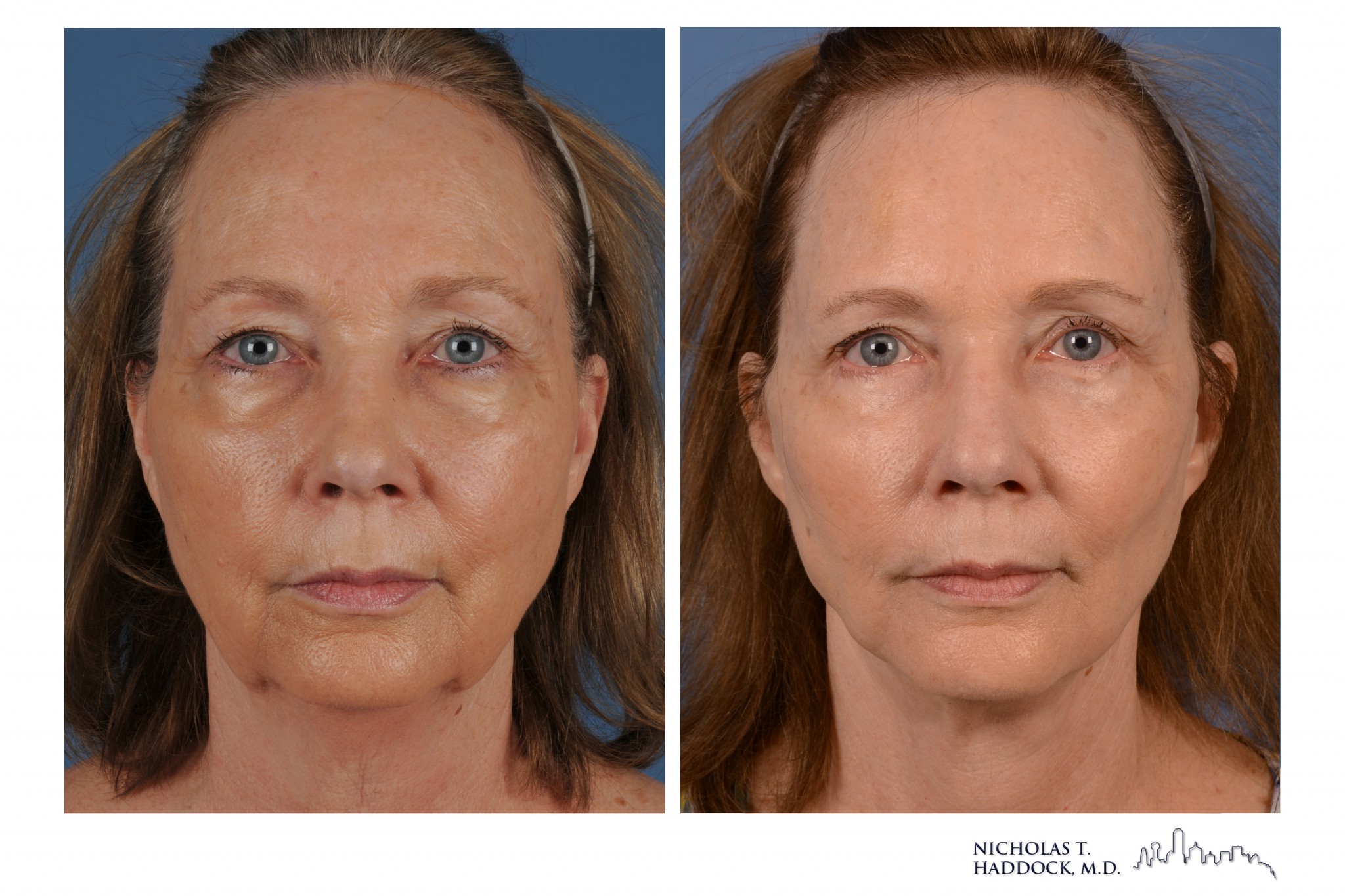 Face Lift Dallas Fort Worth