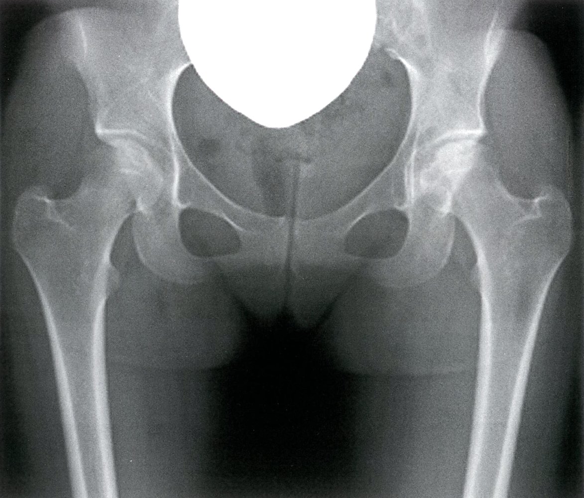 Avascular Necrosis of Femoral Head (AVN) Understanding, Diagnosis, and