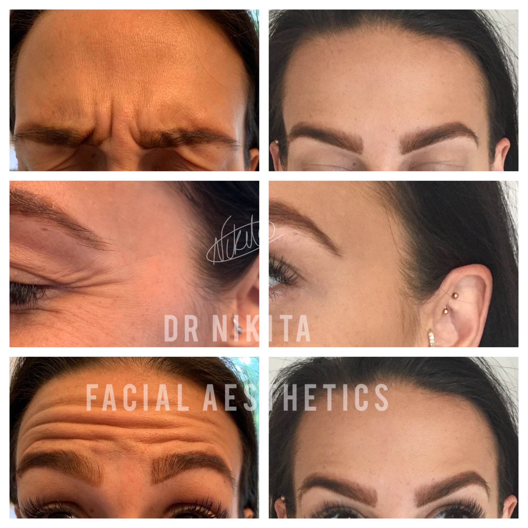 Botox in London Botox Near Me Dr Nikita BDS