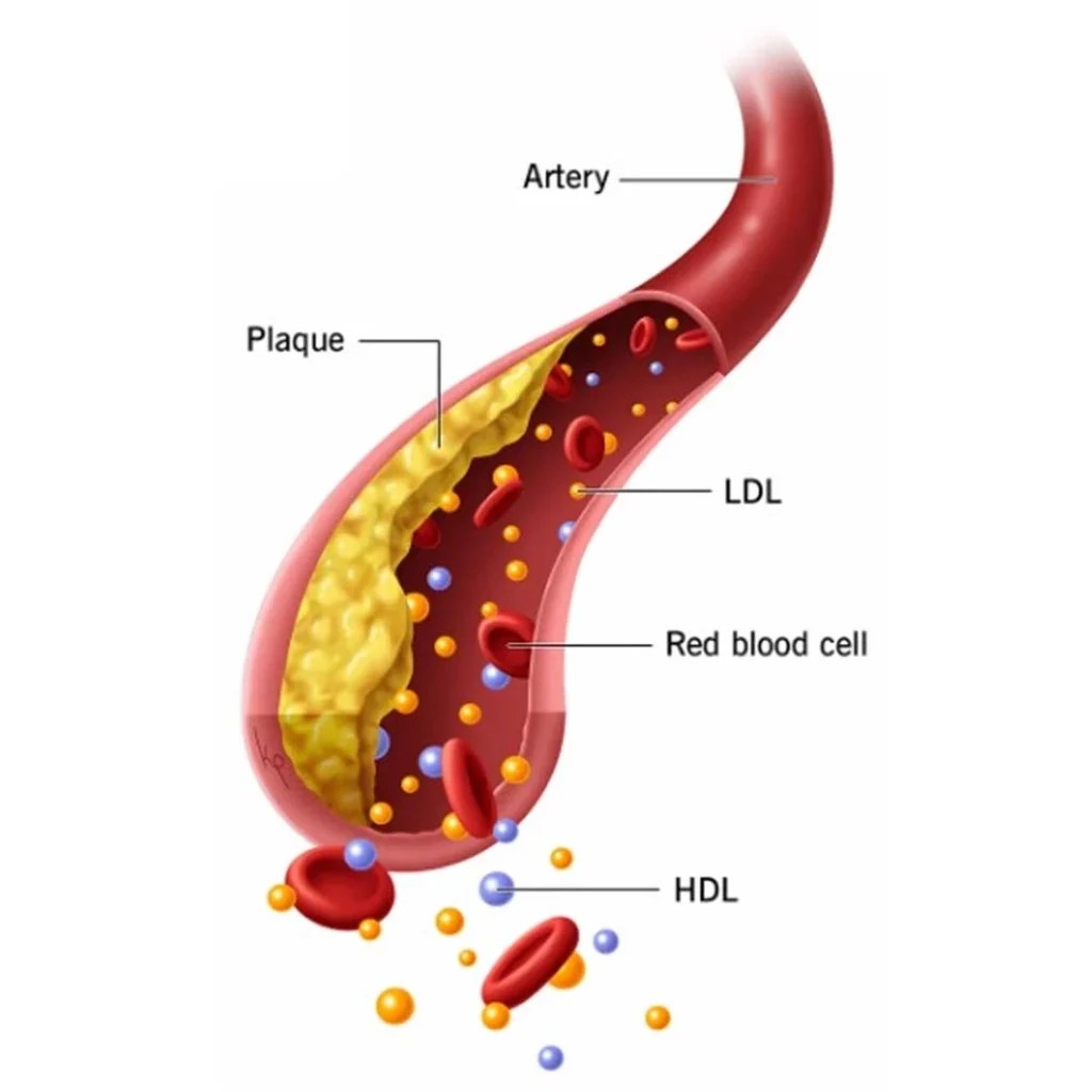 Hyperlipidemia (High Cholesterol) causes, symptoms and prevention