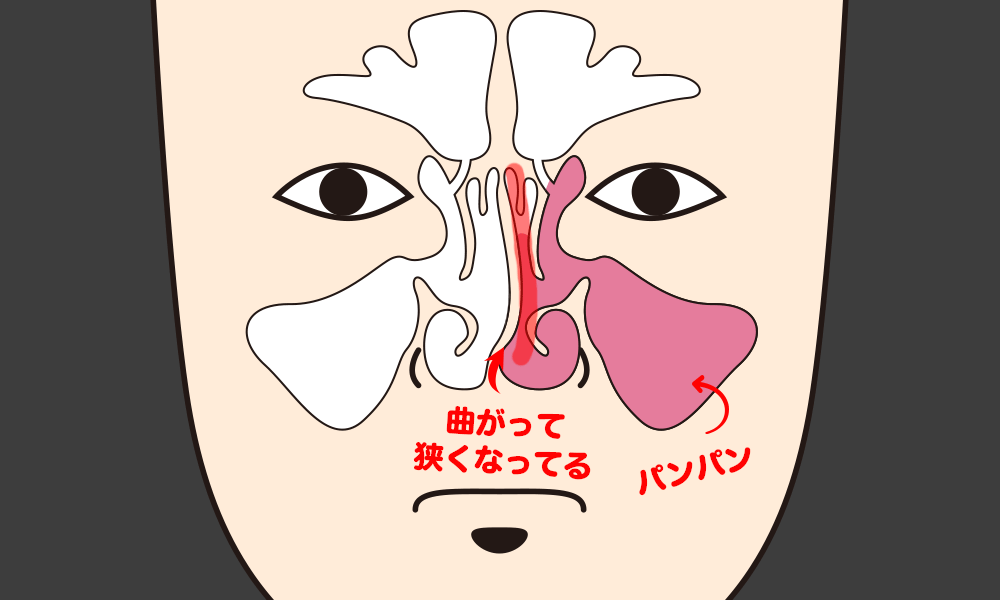 【鼻中隔弯曲症＆副鼻腔炎で入院＆手術】手術前の検査（MRI、麻酔・手術の説明） 3 ｜ dropout! いらんことから逃げ出して日々を