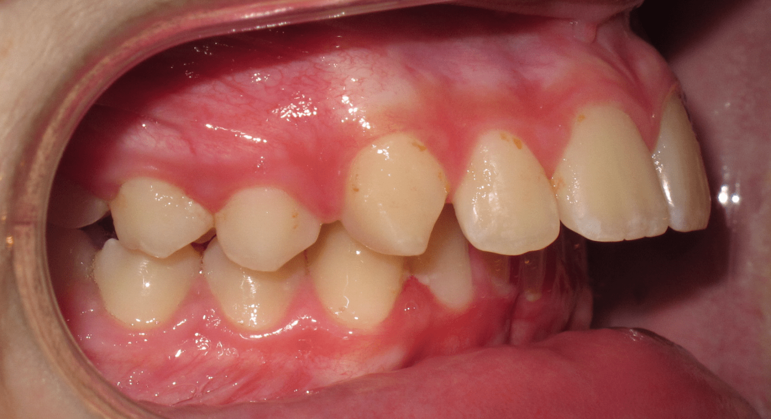 Bites That Can Lead to Chipped Teeth Reagin Orthodontics