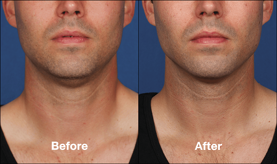 Kybella Double Chin Fat Reduction Northridge Calabasas Los Angeles