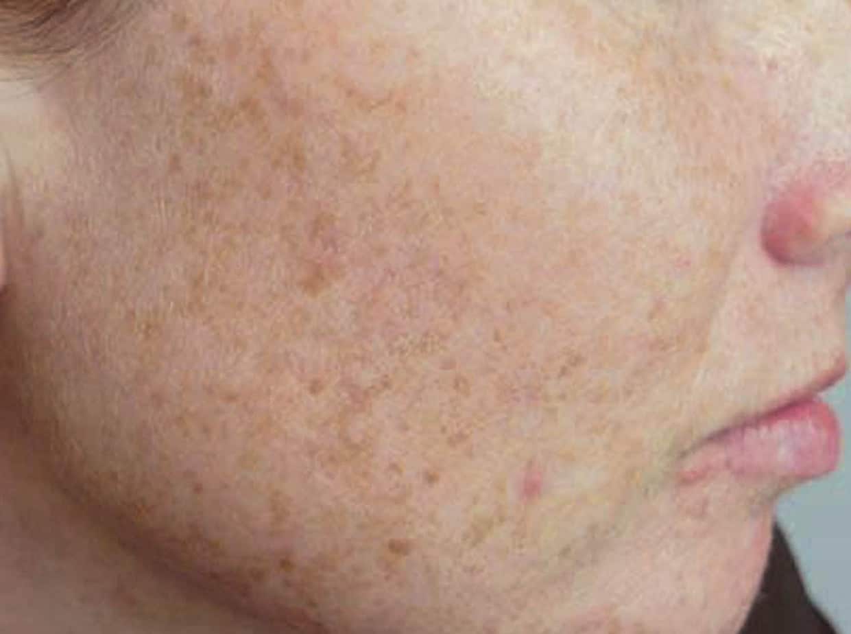 Qué es la Melasma en la cara y la Hiperpigmentación Cuidado Facial