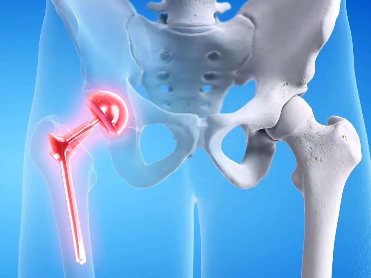 What are the Risks of Delaying Hip Replacement Surgery?