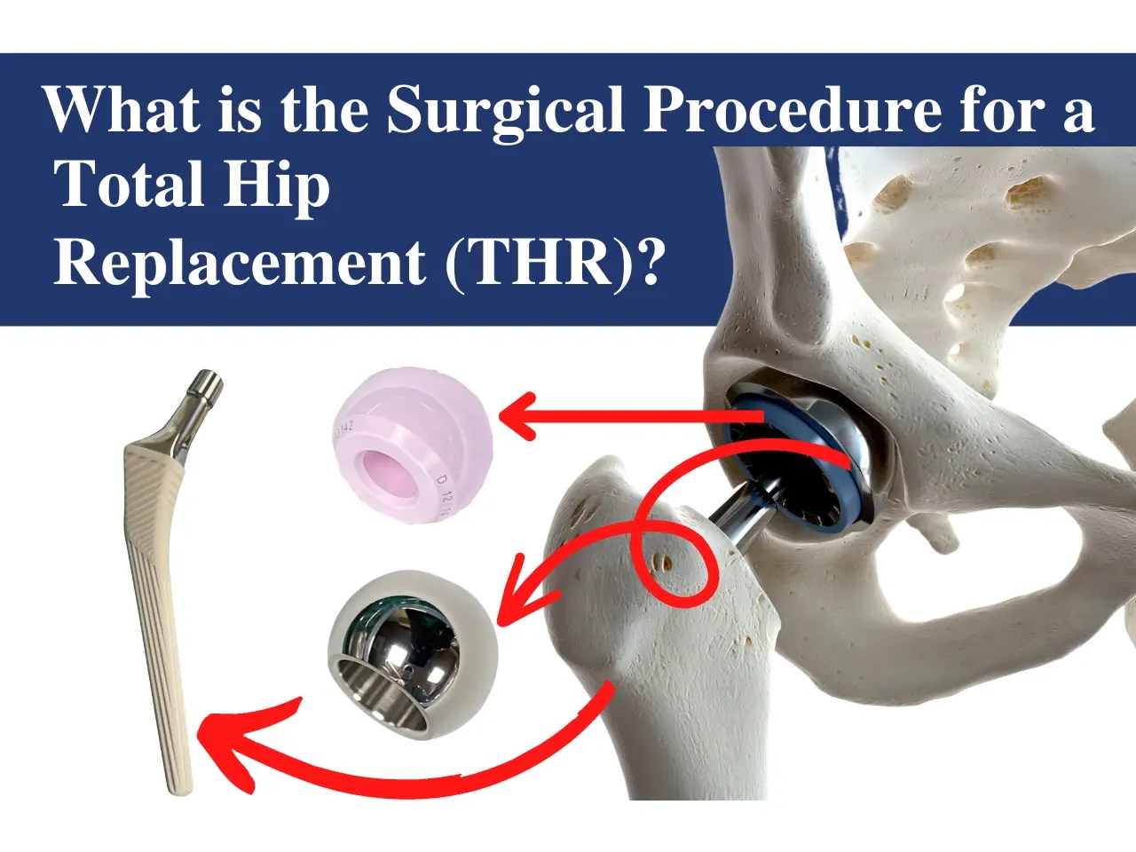 What is Total Hip Replacement Surgical Procedure? Dr. Pankaj