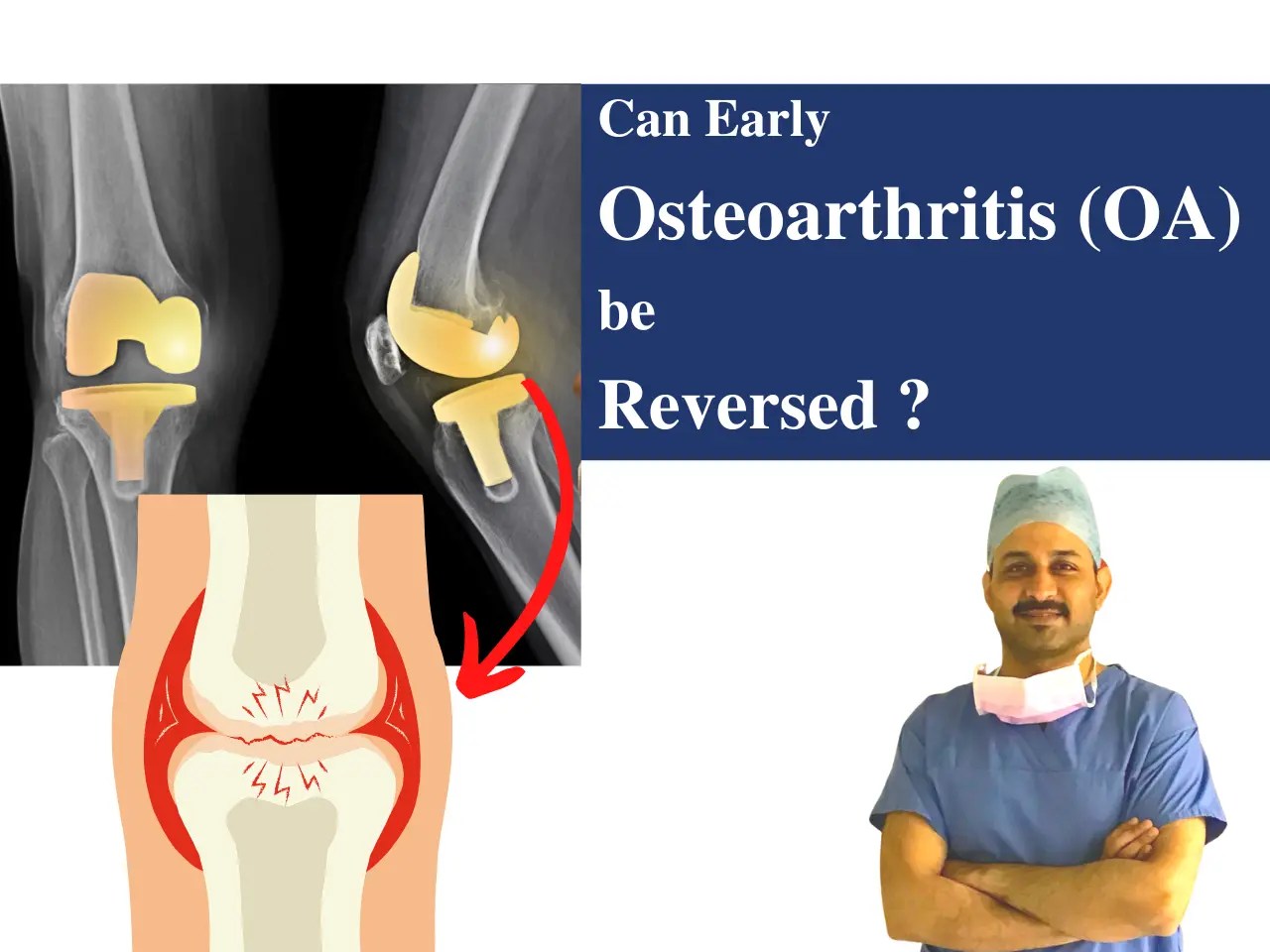 Can Early Osteoarthritis (OA) be Reversed? Dr. Pankaj