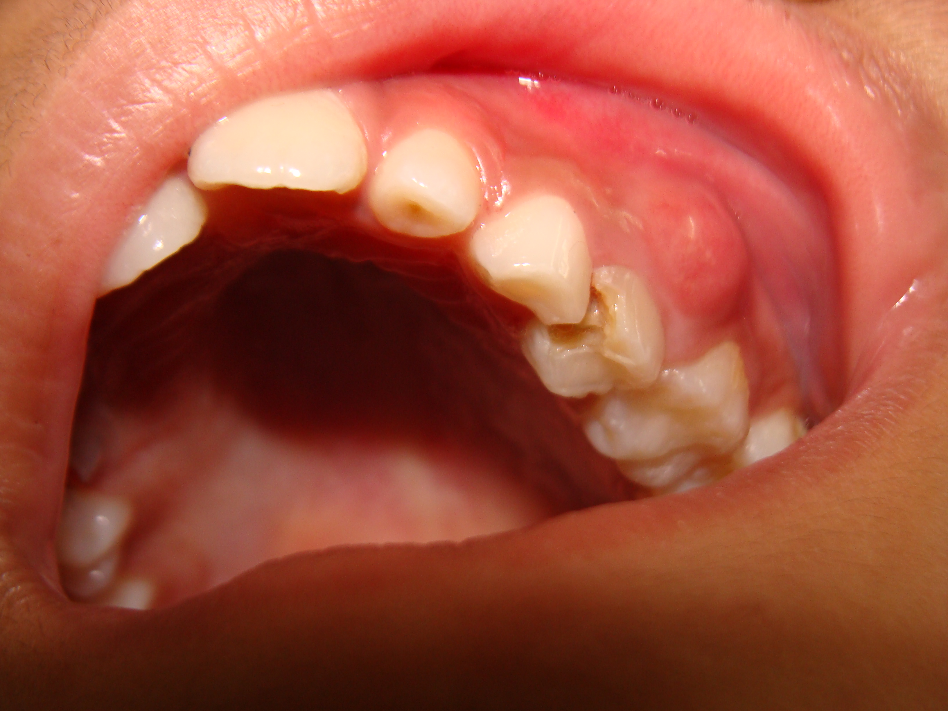 Dental Abscess In Milk Molar At 9years Healthy Scribbles
