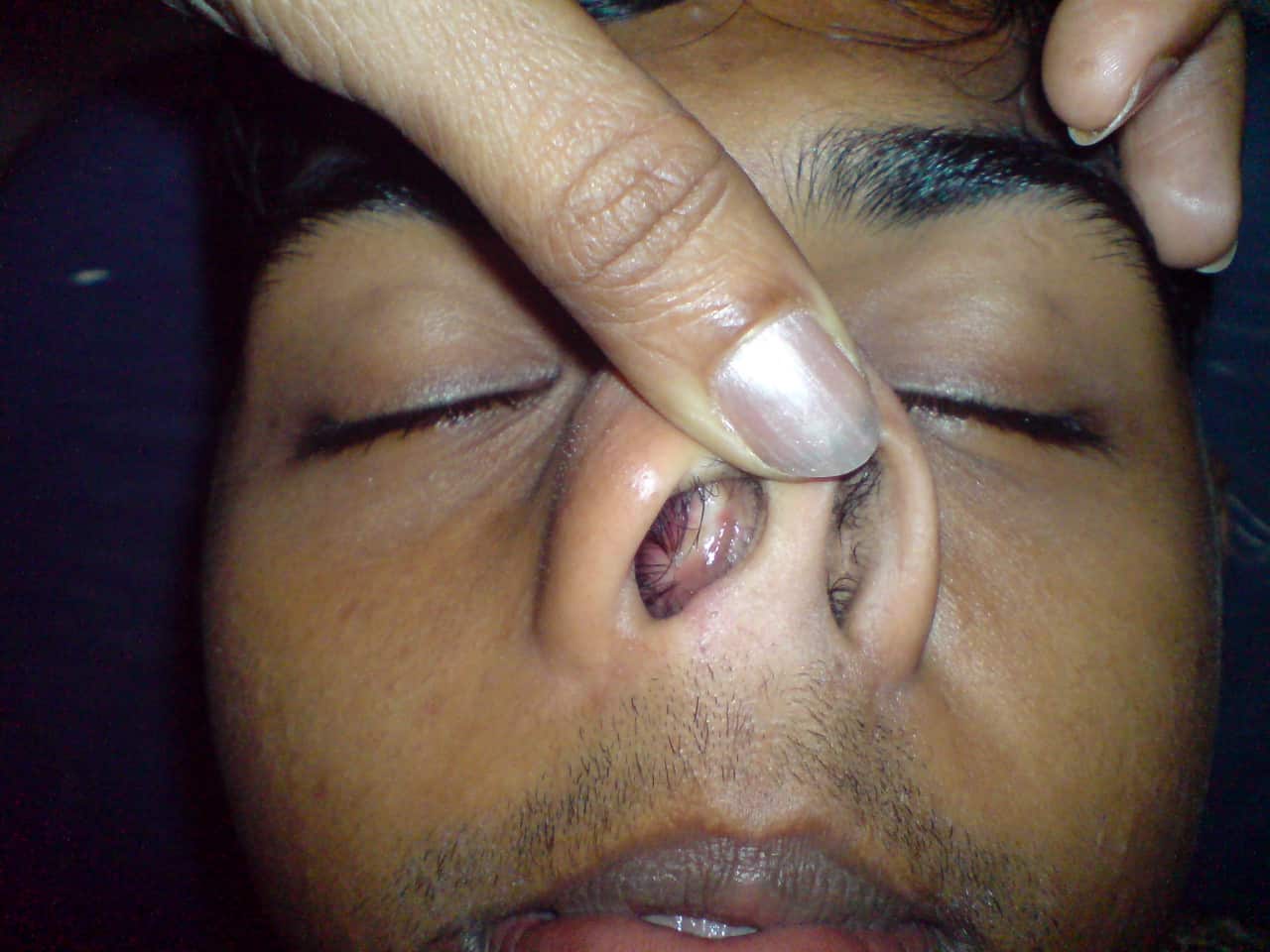 Nasal Septal Deviation How to correct it Dr Paulose
