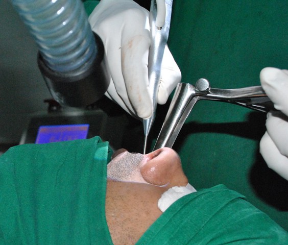 OSA and SnoringLaser Surgery pictures Dr Paulose