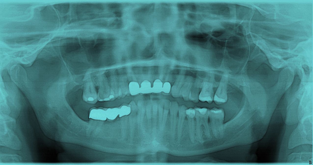 Ear ache and TMJ Dysfunction Dr Paulose