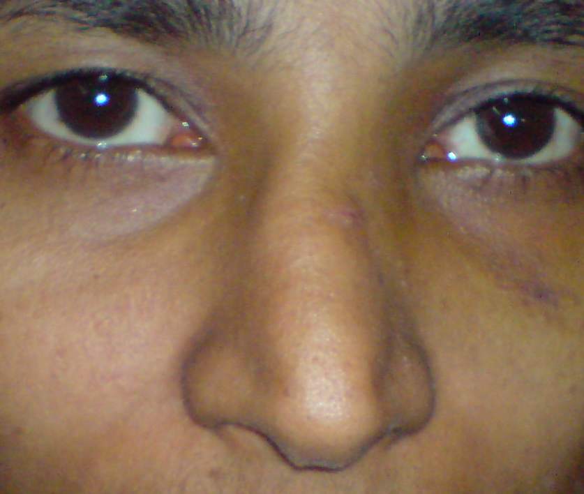 Nasal Bone FractureTreatment Dr Paulose
