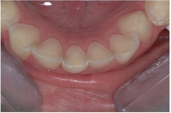 What is Tooth Enamel Erosion? Marielaina Perrone Cosmetic Dentist
