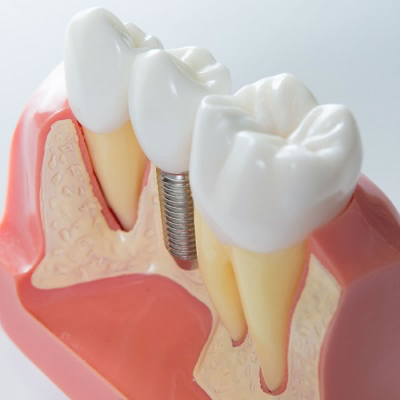 Dental Implantologist Dental Implants in Philadelphia PA
