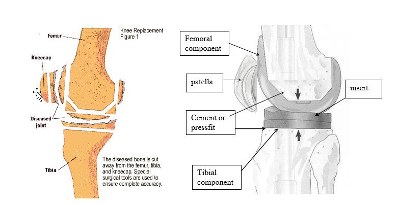 What Not to Do After Knee Replacement: Exercises. Health…
