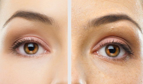 Under the Eye Treatment Filler and PDO Threads Q&A Dr. Gerald