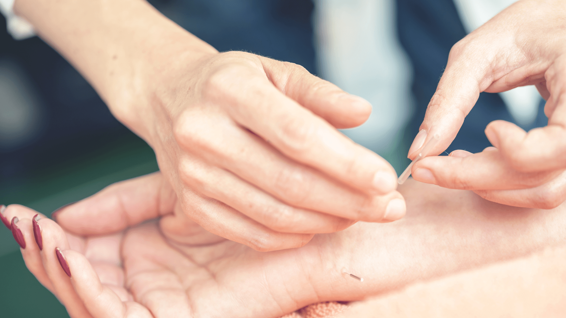 Can Acupuncture Help with Carpal Tunnel Syndrome? DR+ Medical & Paincare