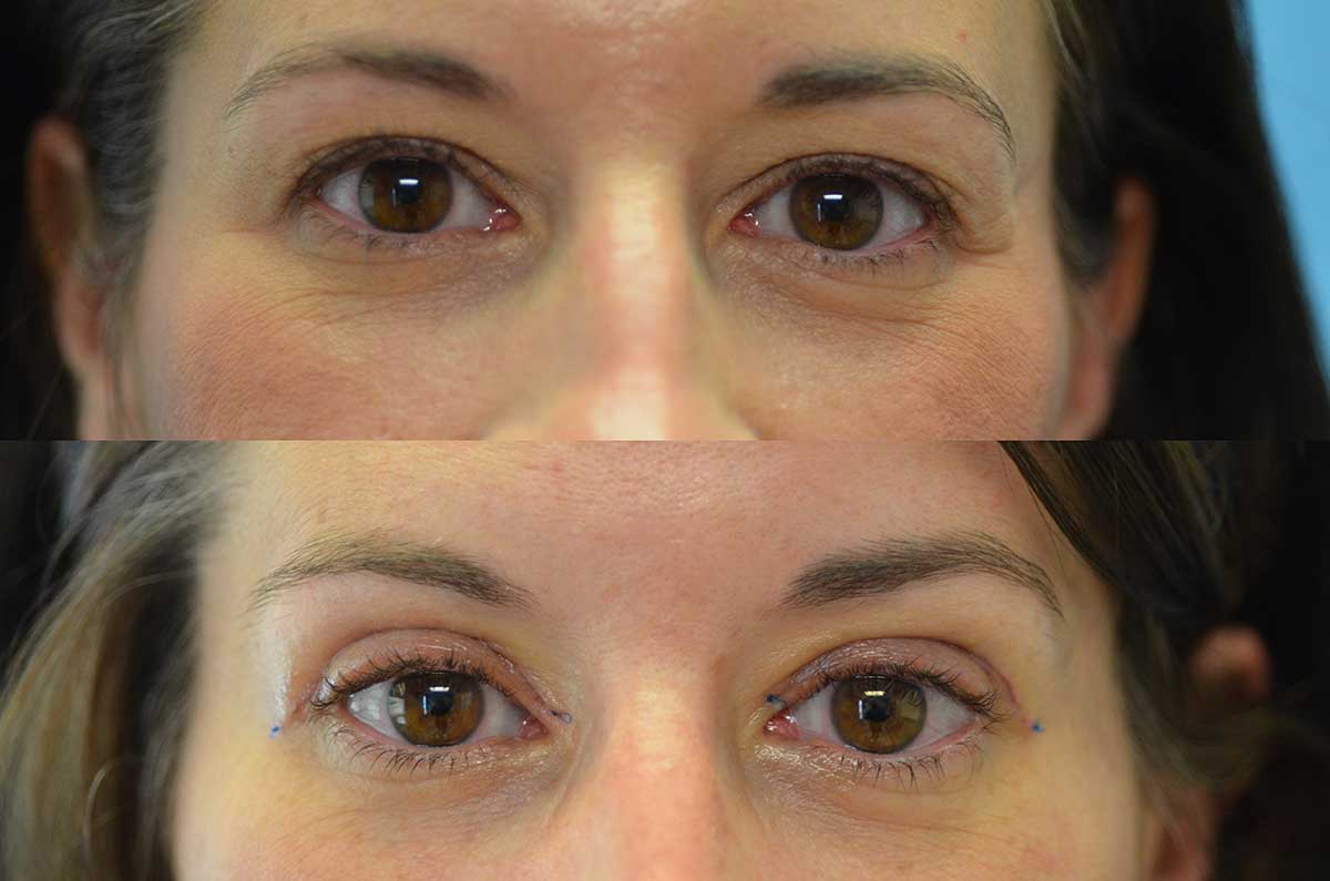 Before and After Park Avenue OculoPlastic Surgeons