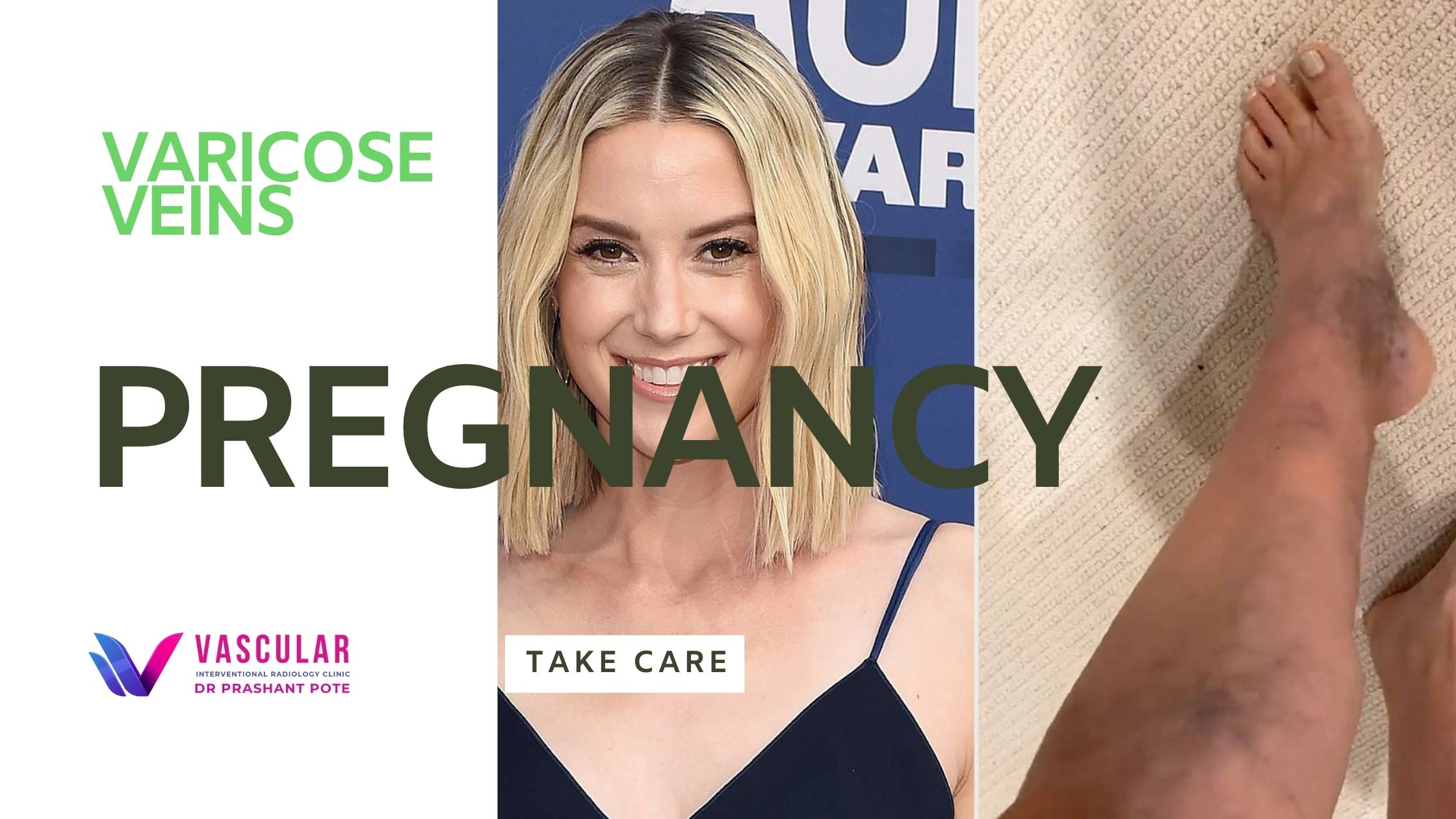 Varicose veins during pregnancy Vascular Care Expert Vascular