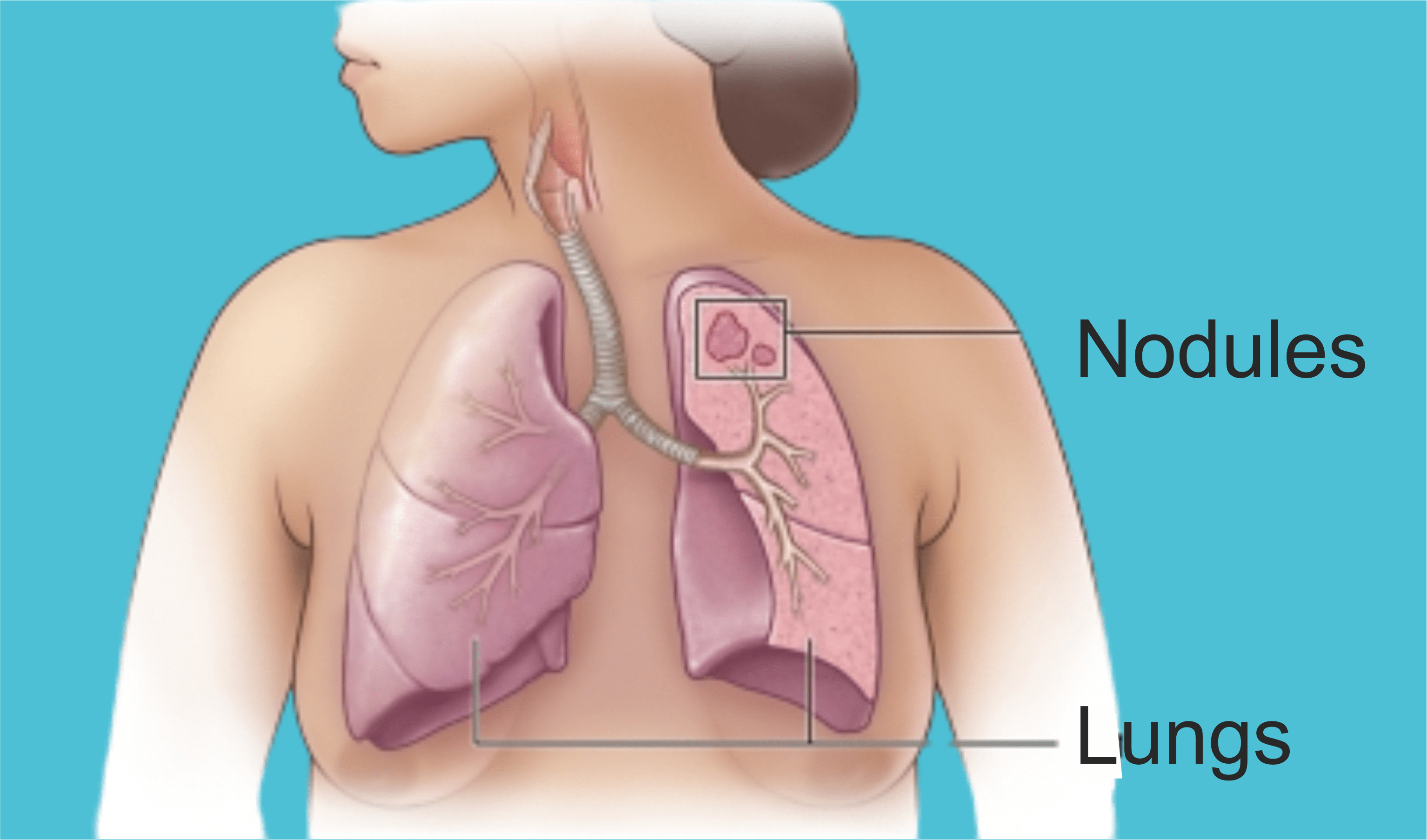 Causes of Lung Nodules Interventional Pulmonology in Goa & Konkan