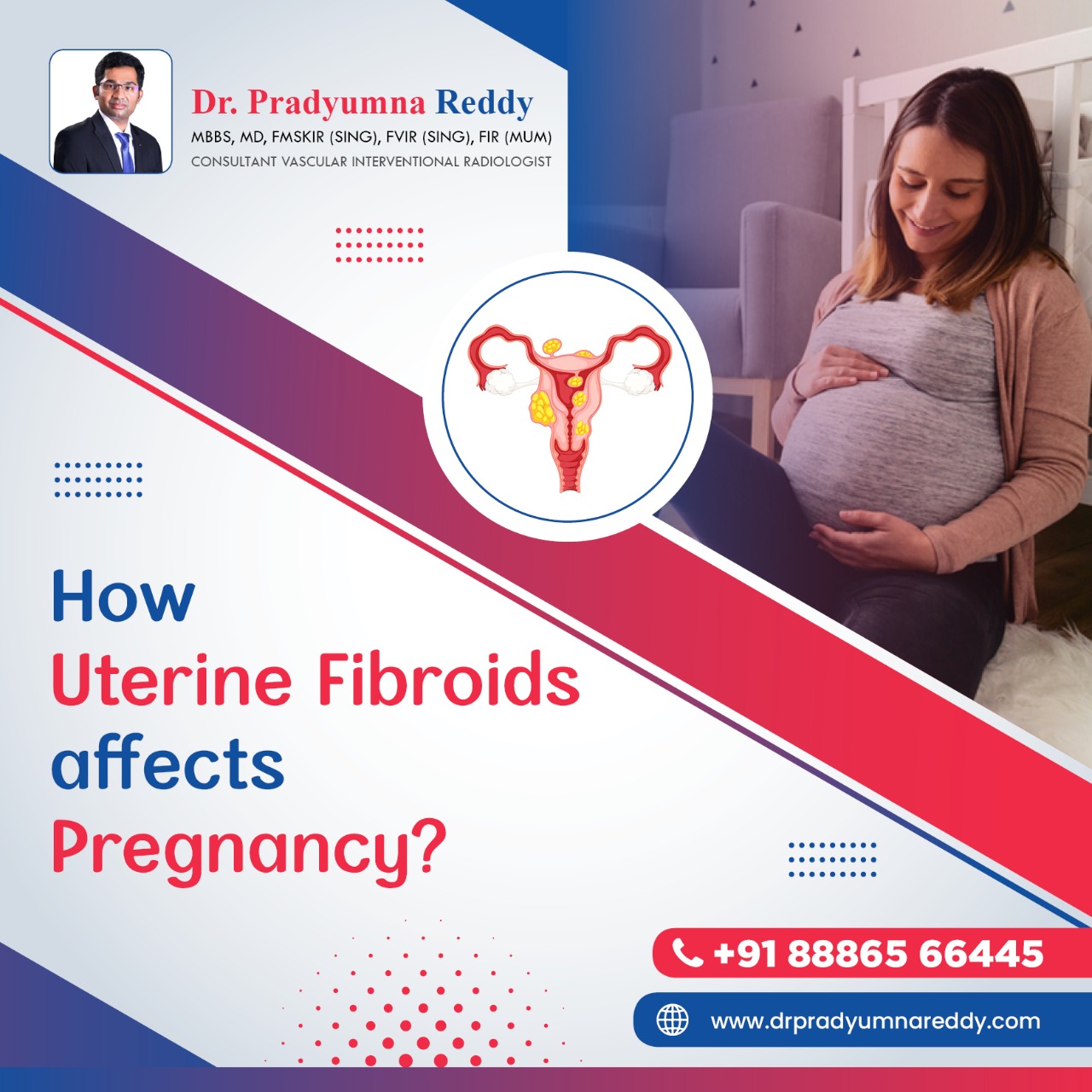 How Uterine Fibroids affect Pregnancy
