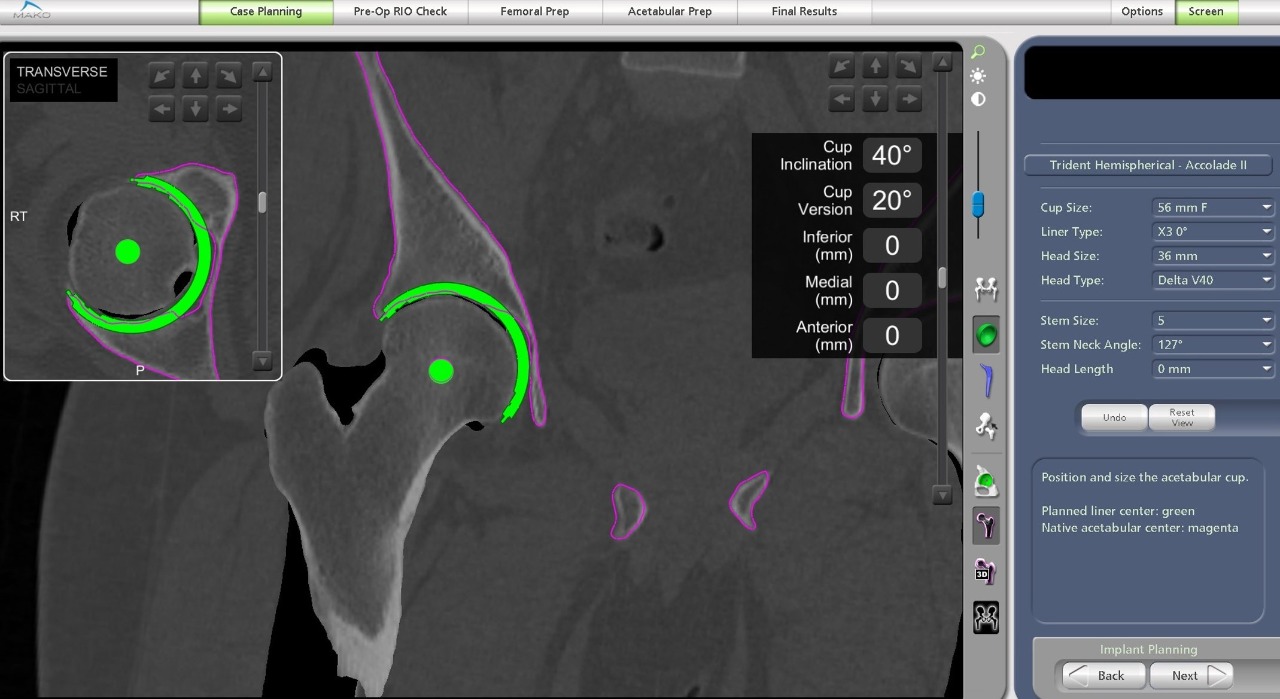 Robotic Hip Replacement in Hyderabad Dr. Praharsha