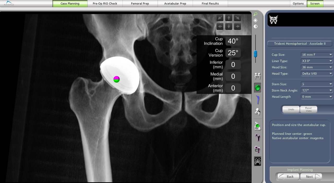 Robotic Hip Replacement in Hyderabad Dr. Praharsha