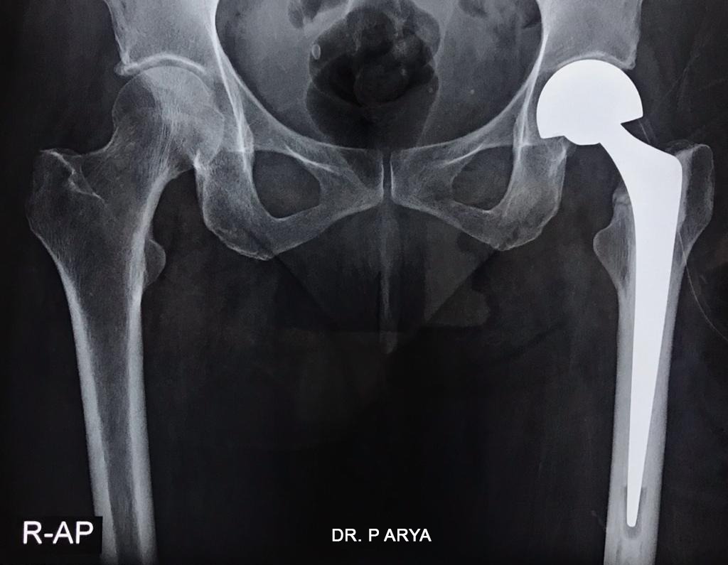 Best Orthopaedic Doctor Performs Hemi Hip Replacement Surgery