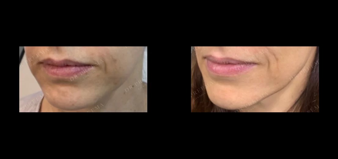 PROFHILO © Dr Preema London Clinic