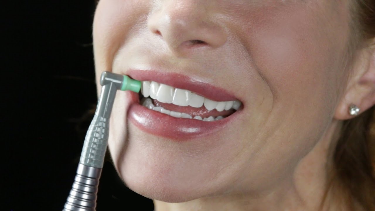 پولیش کردن دندان دکتر یوسف رفیع دندانپزشک زیبایی و ترمیمی در کرج